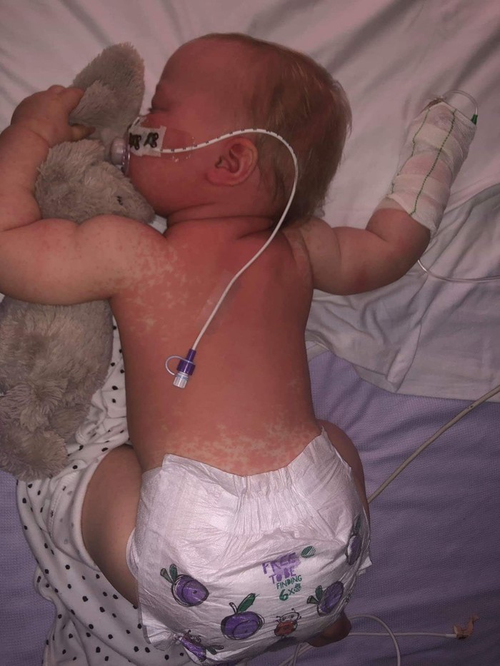 An emotional post from a London family whose baby is now recovering from measles - The medicine, Vaccine, Measles, Parents and children, Parents, Mum, Longpost, Children, Disease