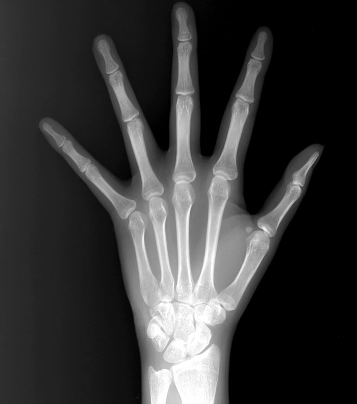 Arachnodactyly (literally spider fingers) - Pathology, Anatomy, Longpost