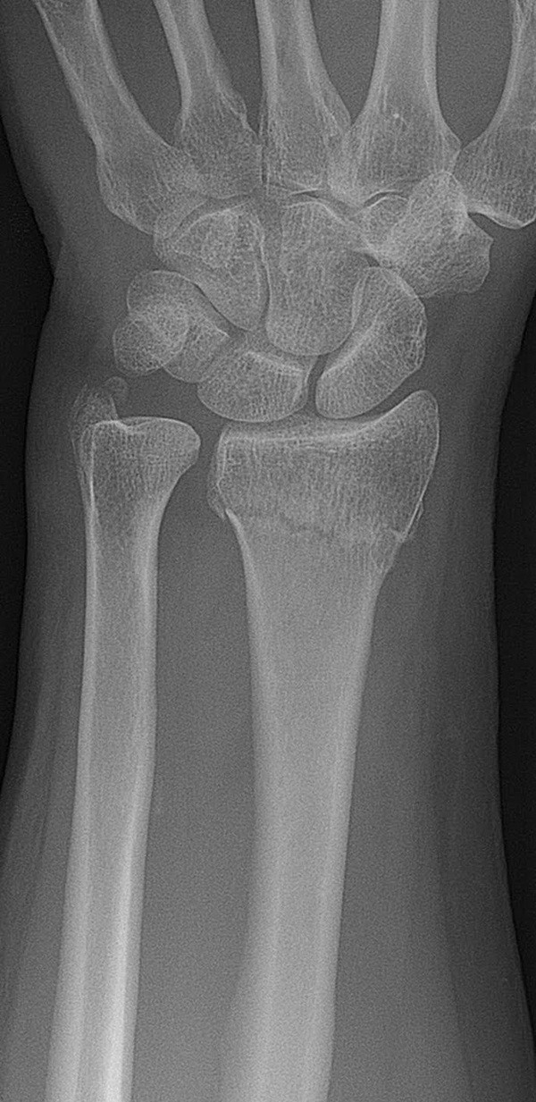 Лечение перелома лучевой кости руки
