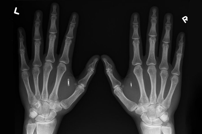 What do you think about implanting RFID in the hand? - Rfid, Sensor