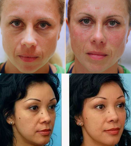 Facial rejuvenation with injections and threads - My, Cosmetology, , , Face, Fillers, Plastic surgery, The medicine, Longpost, Rejuvenation