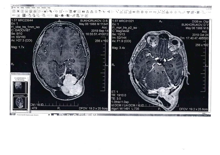 Please Help! The guy has a brain tumor and needs radiation therapy. Unrated post! - My, Radiotherapy, Cancer and oncology, Brain cancer, No rating, Help, Negative