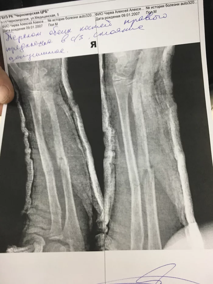 The child broke his arm. - My, Traumatology, Broken arm