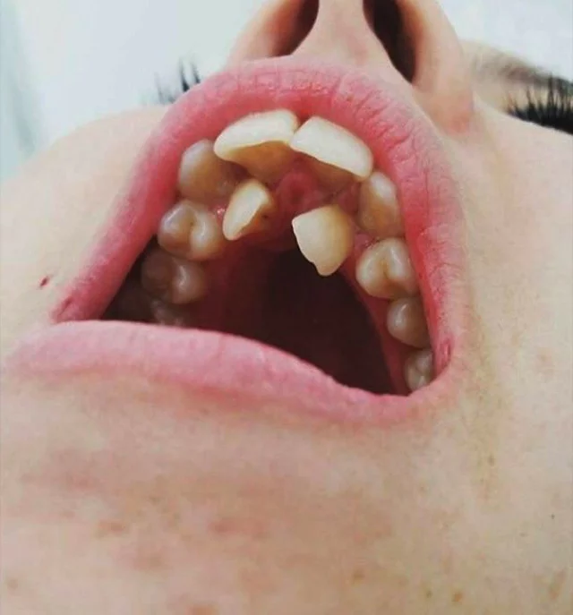 Level X2 - Teeth, Dentist, Longpost
