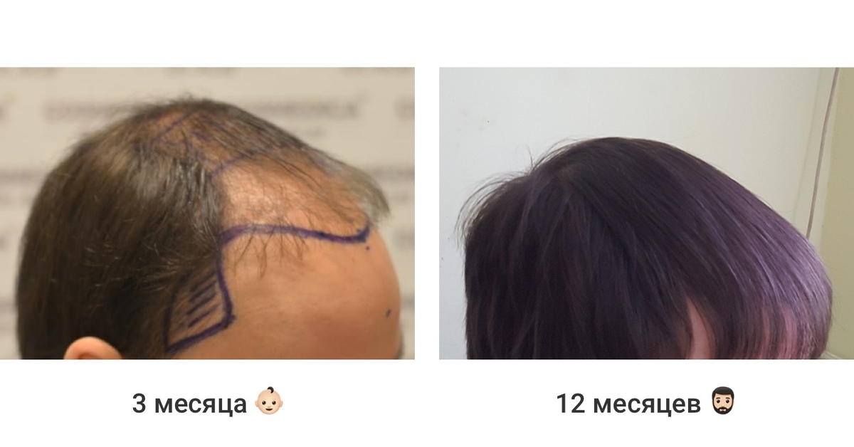 Противопоказания к пересадке волос thumbnail