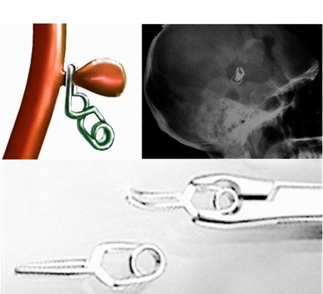 Rupture of a cerebral aneurysm - are there any chances? - My, Aneurysm, Resuscitation, Longpost