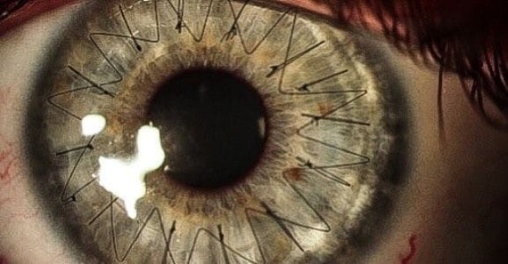 Suture after corneal transplant surgery - Eyes, Operation, Longpost