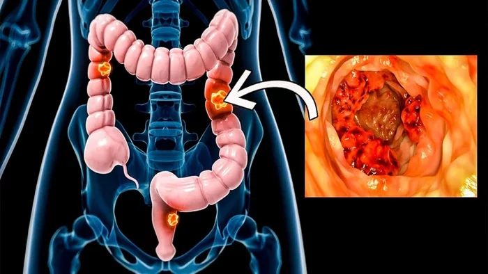 Bowel cancer - My, Cancer and oncology, The medicine, Mat, Intestines, Longpost, Oncology