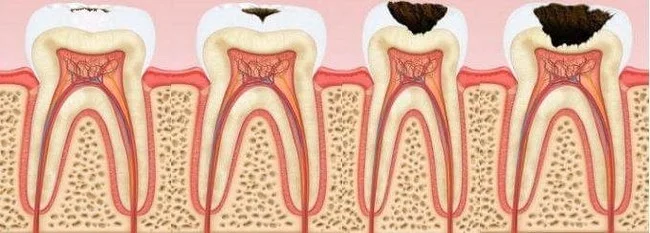 Dentistry - My, Dentistry, Pulpitis, Caries, Periodontitis, Flux, Cyst, Periodontitis, periodontal disease, Longpost