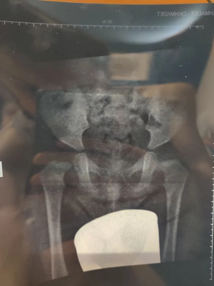 Hip dysplasia in a child - Longpost, Dysplasia, Children, Orthopedics