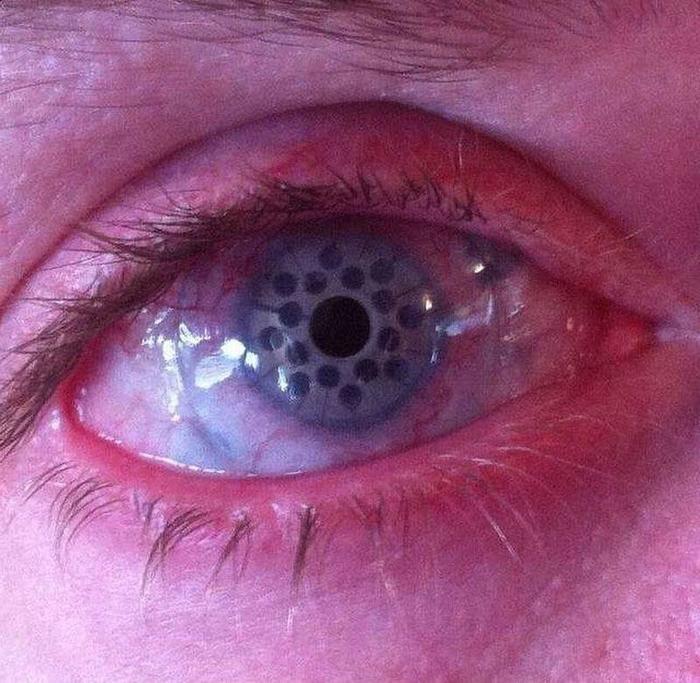 Corneal prosthesis - Eye prosthesis, Cornea, Prosthesis, Eyes, Surgery, Operation