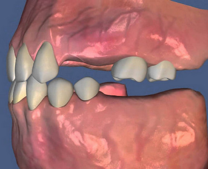 In short, implantation. What kind of animal? - Dentistry, Doctor's appointment, The medicine, Longpost