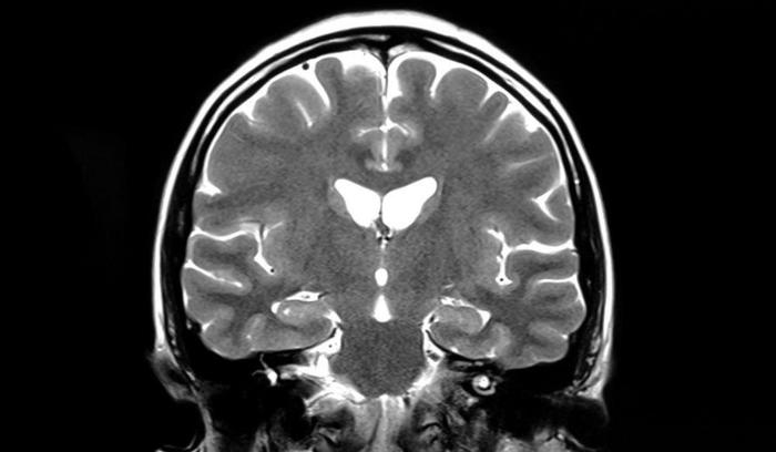 Researchers have studied the brains of bullies and discovered features in its structure - Brain, The size, Hooligans, Scientists, Research, MRI, news