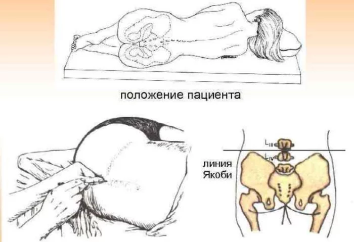 Lumbar puncture. Myths, expectations, reality - My, Infection, Meningitis, Puncture, The medicine, The patients, Pain, Longpost