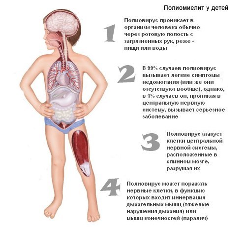 Полиомиелит Шредингера: если вакцинироваться, его как бы нет, а если нет, то он как бы есть! - Вакцина, Полиомиелит, Здоровье, Иммунизация, Длиннопост, Вирус