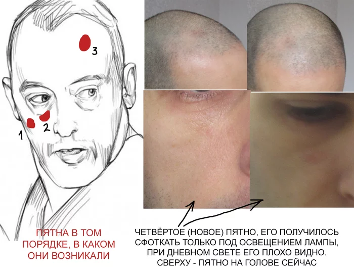 Диагноз по фотографии - Моё, Диагноз, Дерматология, Медицина, Загадка, Длиннопост