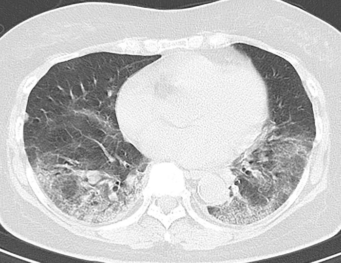 нижнедолевая пневмония на кт. матовое стекло и консолидация на кт. вирусная пневмония на кт. липоидная пневмония кт. пневмония на кт.
