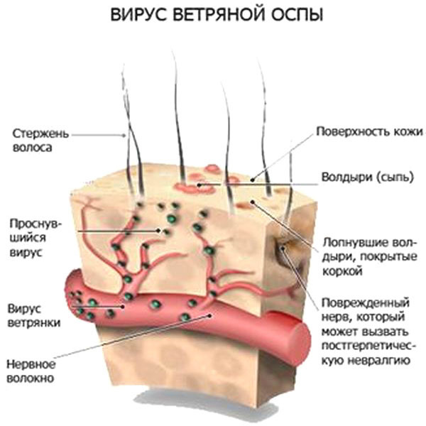 Chickenpox or chicken pox - Vaccine, Graft, Chickenpox, Health, Longpost, Vaccination