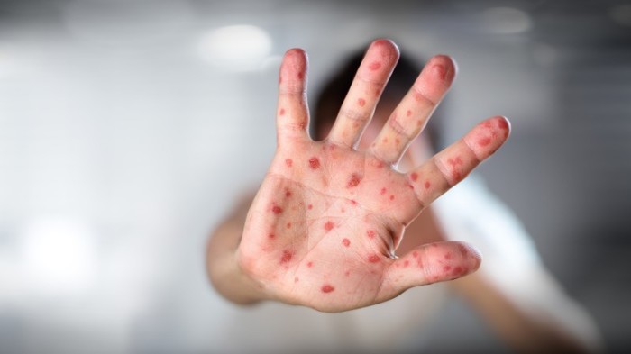 The UN warns that millions of people could become ill with measles in the near future. - Coronavirus, The science, news, UN, People, Society, Disease