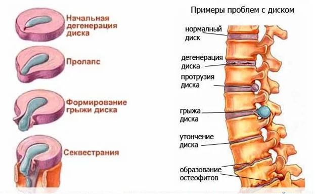 Резорбция грыжи межпозвонкового диска. Реальный пример и теория - Моё, Неврология, Межпозвоночная грыжа, Боли в спине, Личный опыт, Здоровье, Медицина, Доказательная медицина, Длиннопост