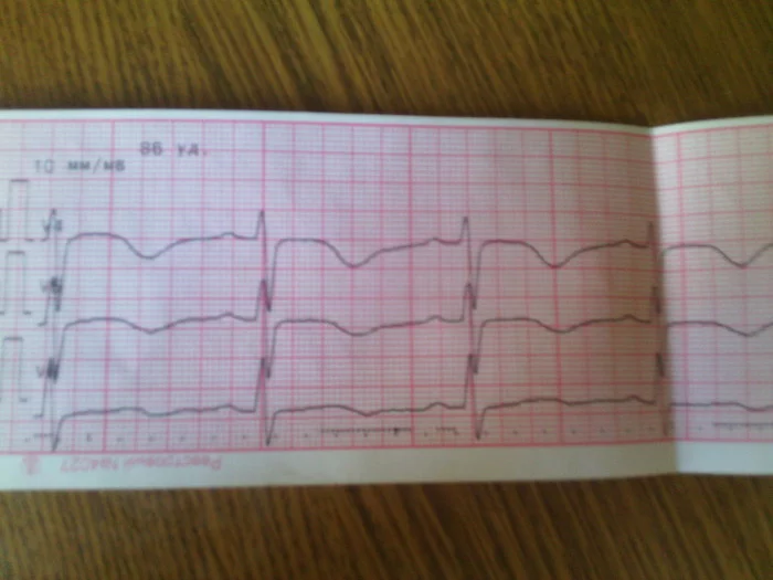 Please help me decipher the ecg #ecg - My, The medicine, ECG, Cardiology, Longpost