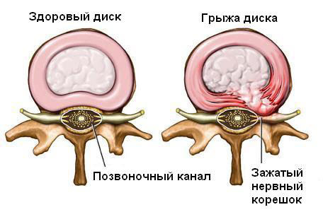 Disc herniation: treatment cannot be operated. Does the doctor add a comma? - My, Neurology, Hernia, Pain, Operation, Saint Petersburg, Efficiency, Longpost