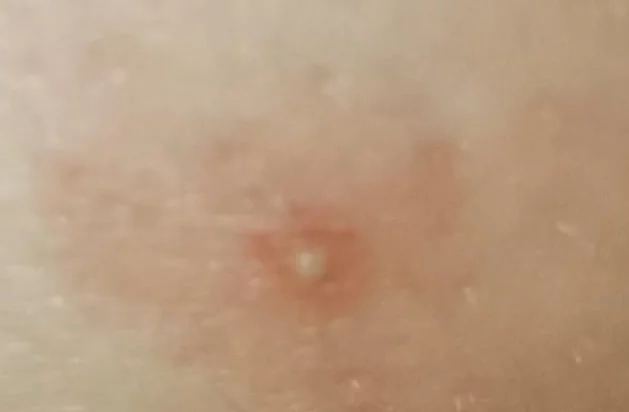 Someone bites at home. We just can’t figure out who it is. Help with advice - My, Insects, Bite, Text