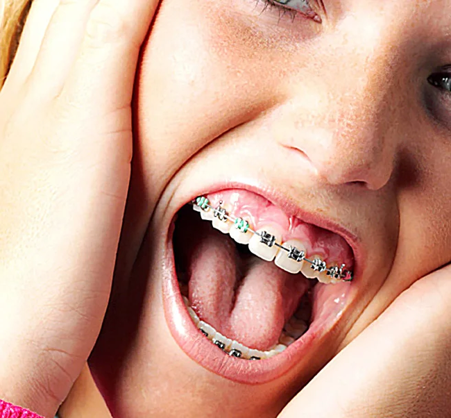 Do braces hurt? - My, Braces, Dentistry, Orthodontics, Orthodontist, Longpost