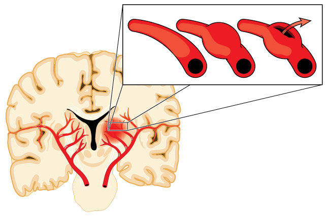 Notes of a stroke patient. Survived a stroke at 46 years old - My, Stroke, Hemorrhagic stroke, Blood vessels, Health, Blog, Longpost