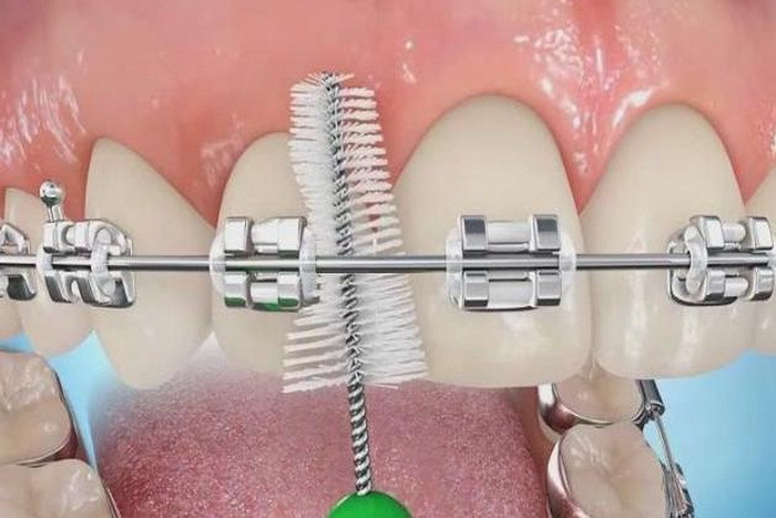 Braces at 28 - My, Braces, Teeth, Pain, Longpost, Dentistry