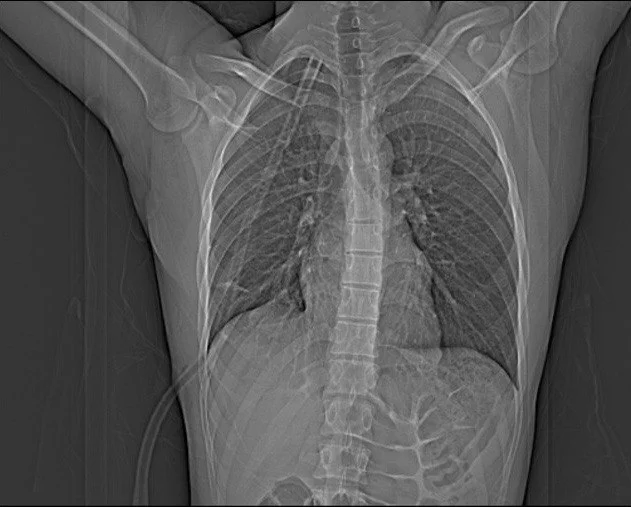 Pneumothorax - Lungs, Pneumothorax, X-ray