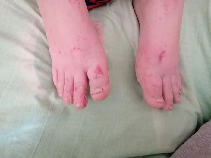 Please help, my son asks to cut off his legs - Help, Doctors, Dermatology, Longpost, No rating, Children, Childhood diseases