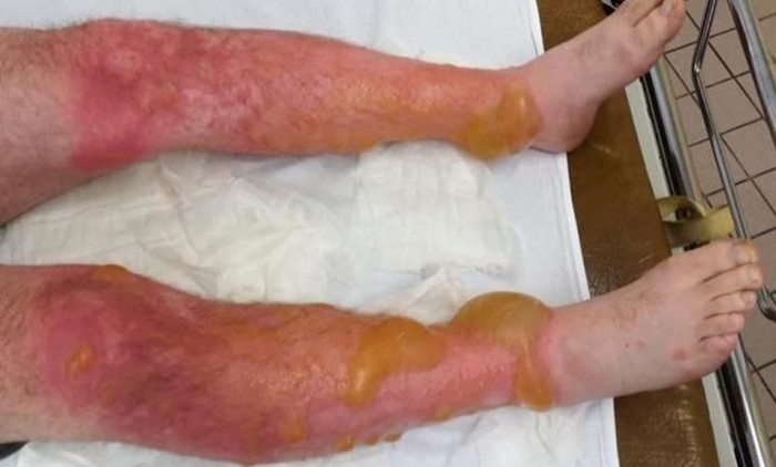 В Астраханской области нашествие ядовитых змей и пауков каракуртов Россия, Коронавирус, Длиннопост, Негатив, Астраханская область, Ядовитые животные, Паук, Укус, Борщевик, Опасность, Военные учения