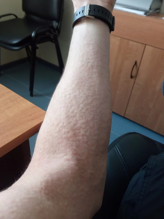 Нужна помощь - Моё, Дерматология, Алергики, Аллергия, Длиннопост