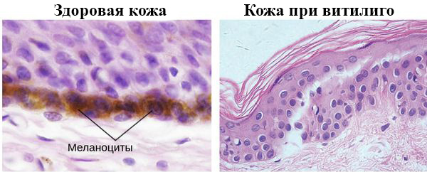 What is vitiligo? + skin under a microscope - My, The medicine, Disease, Vitiligo, Histology, Longpost, Pigmentation