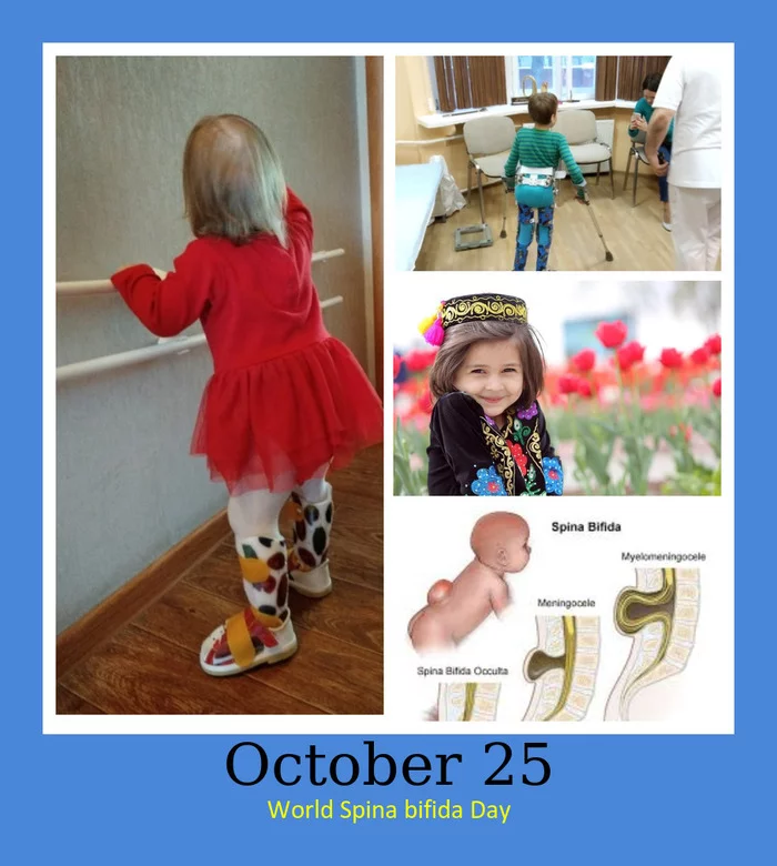 October 25th – World Spina Bifida Awareness Day - International day, Disease, Children, Wheelchair Disabled, Fund, Spine, Longpost