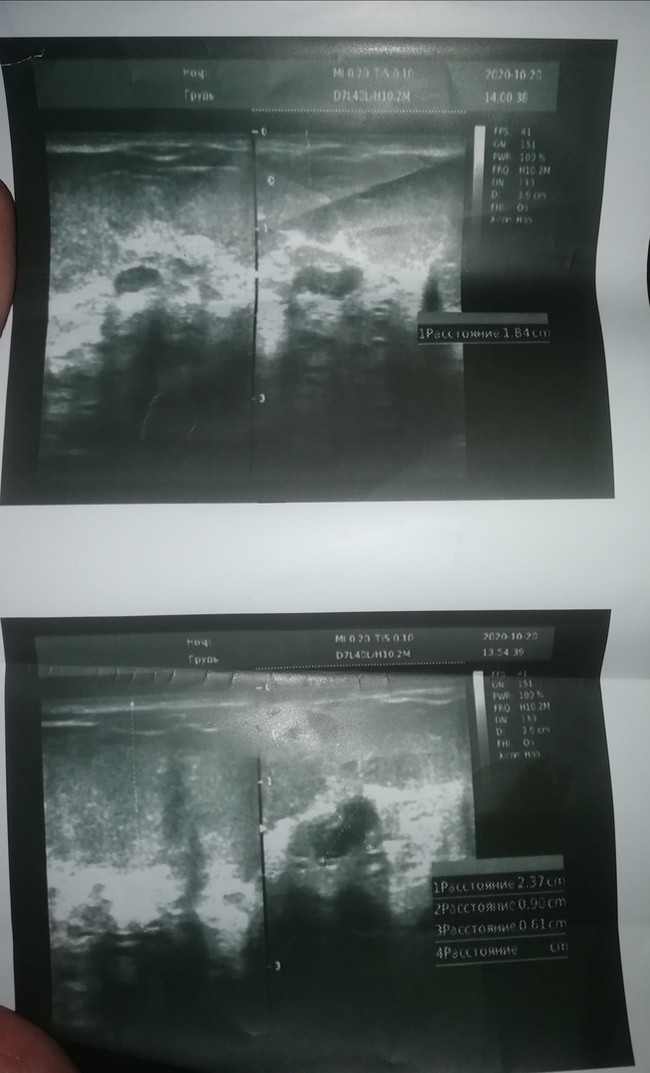 Need advice - fibroadenoma, cyst and other previously unknown delights - My, Mammalogy, Cyst, Question, The medicine, Longpost