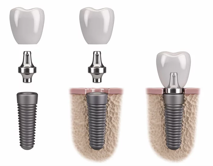 Dental implants. We're trying to figure it out - My, Dentistry, Implants, Longpost