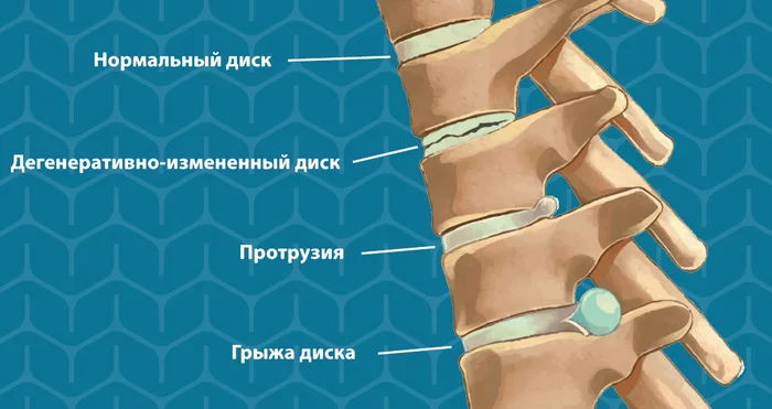 Грыжа - старая, новая, твоя! В чем различие этапов? Можно ли помешать выздоровлению? - Моё, Медицина, Врачи, Хирургия, Операция, ЗОЖ, Самолечение, Клиники, Организм, Анатомия, Грыжа, Позвоночник, Спина, Видео