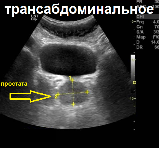 Digital rectal examination - Prostate, Urology, The medicine, Longpost