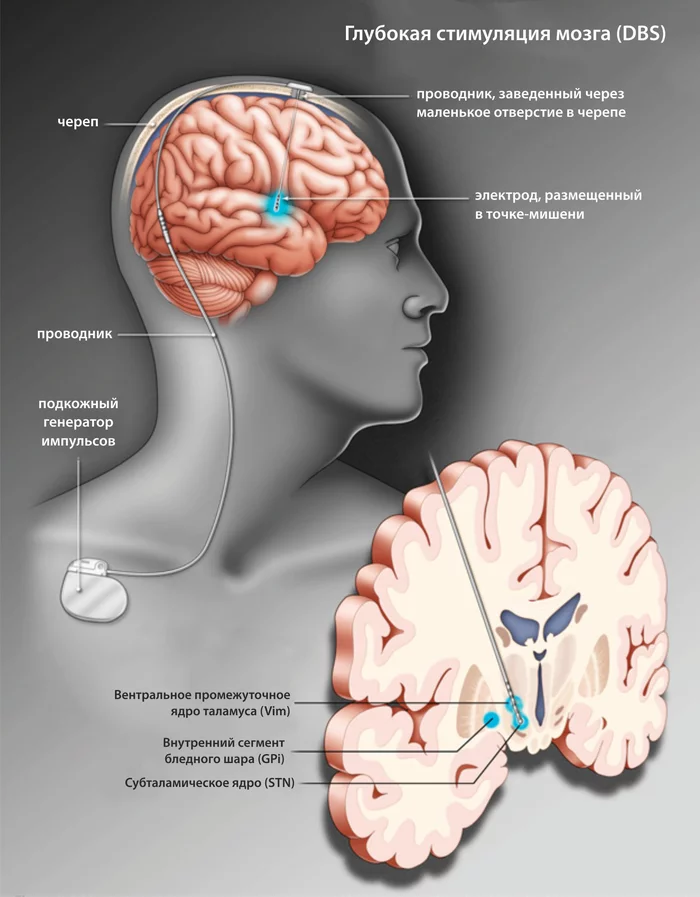 Deep brain stimulation for Parkinson's disease - Parkinson's disease, Dbs, Longpost