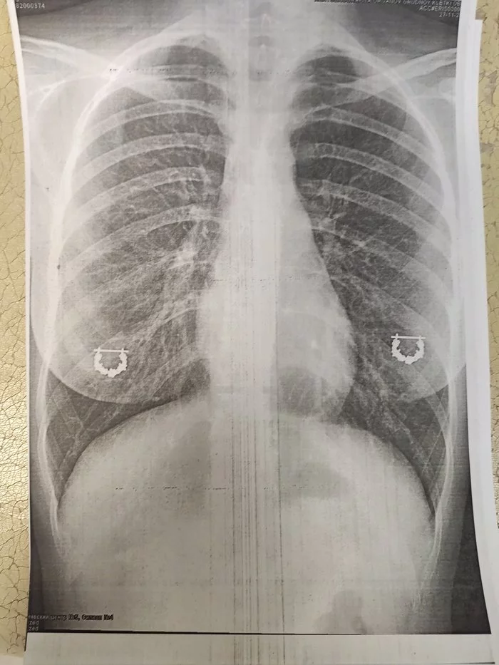 Snapshot - Hospital, Breast, Piercing, X-ray