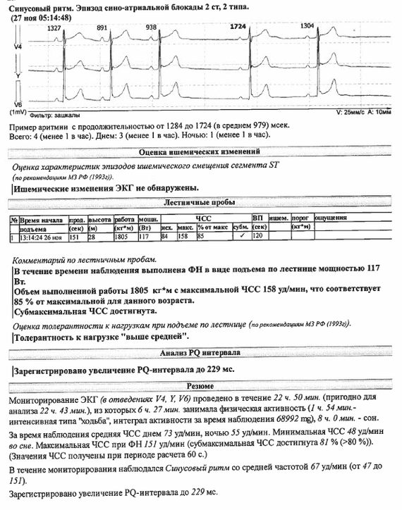 Экстрасистолия (нужен совет) - Моё, Экстрасистолия, Сердце, Без рейтинга, Длиннопост, Нужна помощь врачей