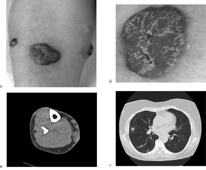 What is needed to prescribe treatment for lymphoma? - My, Lymphoma, Cancer and oncology, Diagnostics, The medicine, Longpost