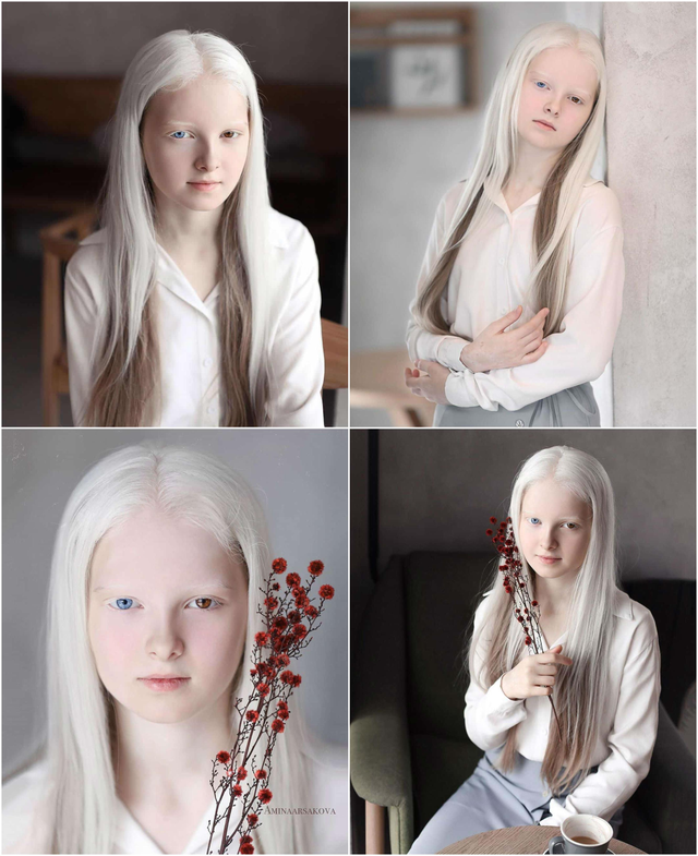 A girl with albinism and heterochromia. Amina Ependieva. Born on 11/12/2008 in Chechnya in Russia - Girls, The photo, Incredible, Albino, Heterochromia