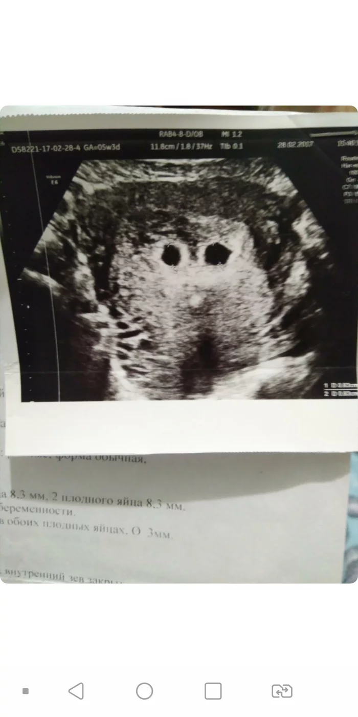 The story of one non-abortion - Twins, Abortion, Gynecologist, Ultrasound, Longpost