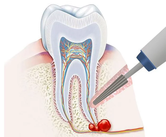 Tooth cyst: treatment cannot be removed. Where do we put the comma? - My, Dentist, The medicine, Doctors, Cyst, Longpost