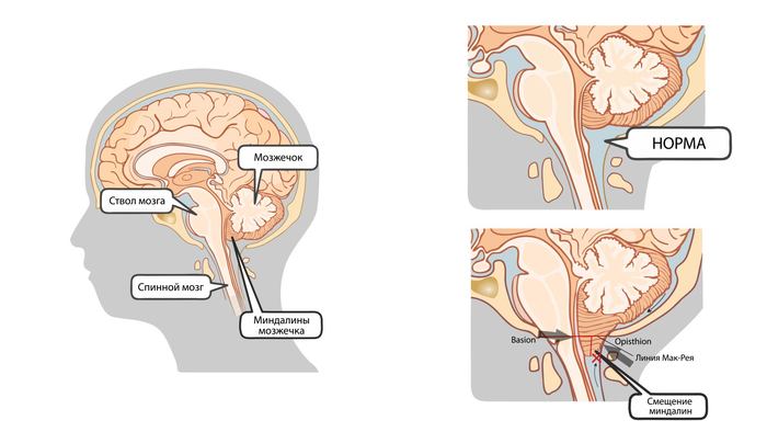 Chiari malformation (anomaly). The path from diagnosis to treatment - My, Neurosurgery, Neurology, Arteriovenous malformation, Video, Longpost