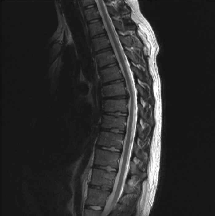 Грыжа позвоночника. Вопрос к неврологам и нейрохирургам - Моё, Межпозвоночная грыжа, Спинной мозг, Длиннопост, Нейрохирургия, Неврология, Позвоночник, Медицина