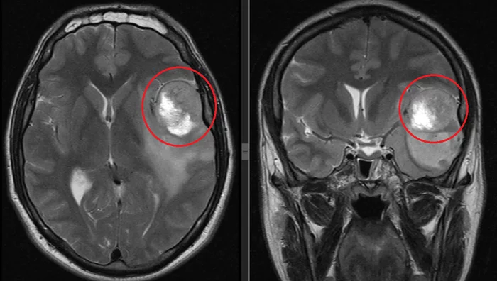 Sad stories from a doctor's appointment - My, MRI, Neurology, The medicine, Health, Treatment, Life stories, Morality, Longpost, Negative, Cancer and oncology, Disease